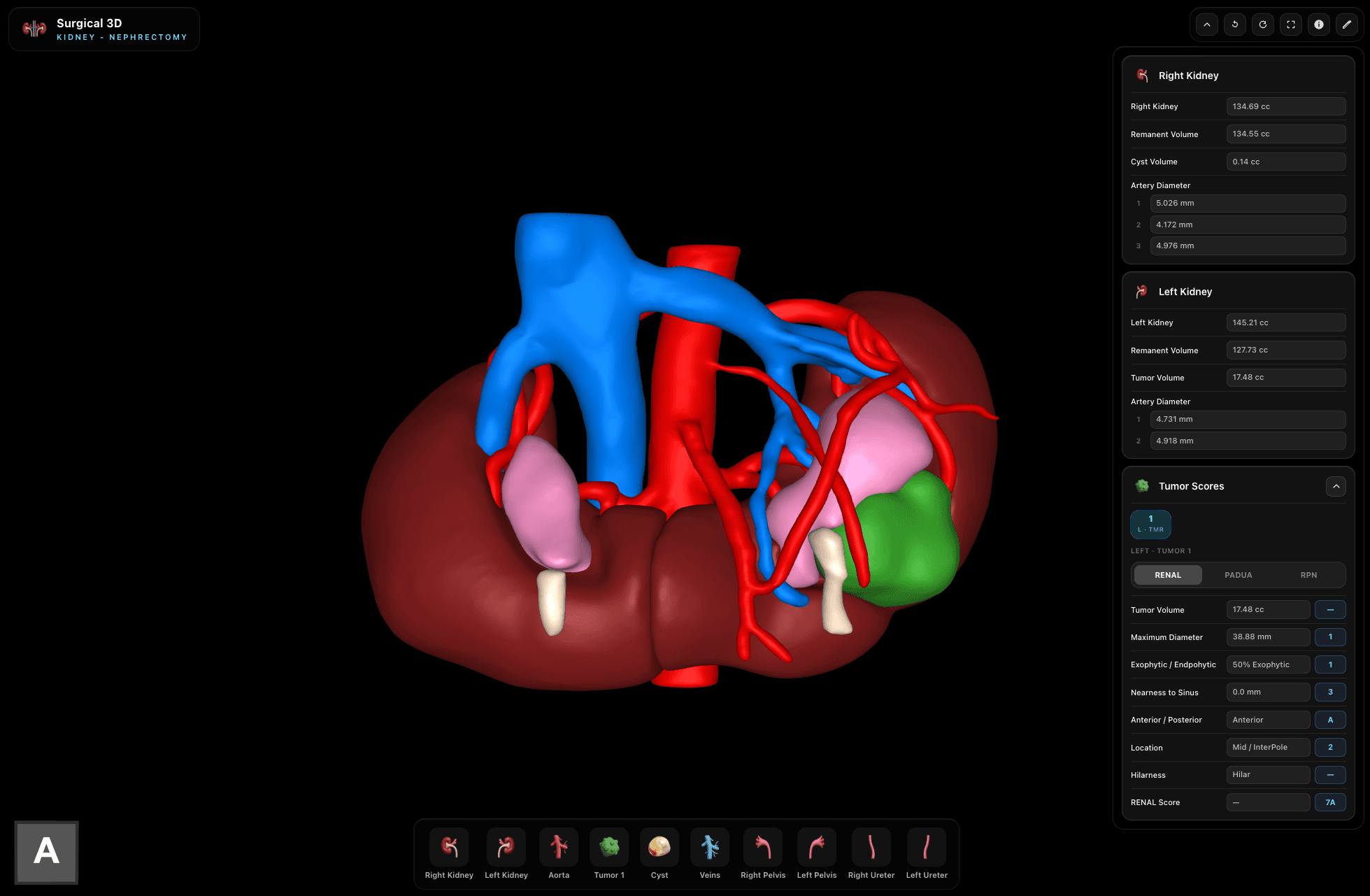 Kidney 3D reconstruction
